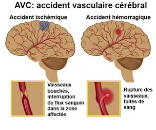 avc-accouchement-grossesse-aide